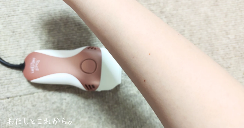 ケノンで脱毛完了した腕の写真