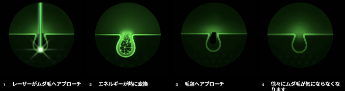 トリアのレーザー脱毛の仕組み