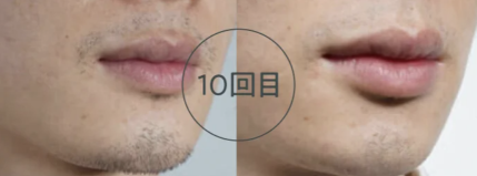ヒゲ脱毛のビフォーアフター写真